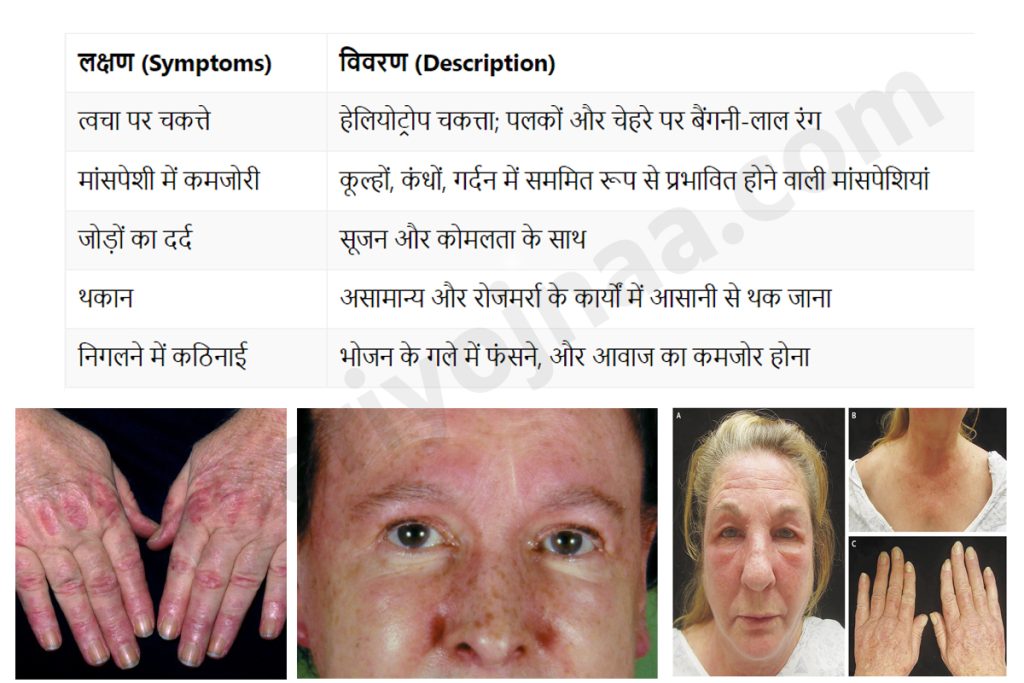 Symptoms of Dermatomyositis